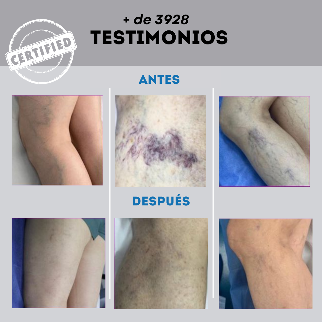 🚨(2x1)🚨Varicose Veins™ - Elimina Várices Rápidamente con el Spray Veins! 🌿 Alivio Efectivo y Natural 🚨2por1 😱