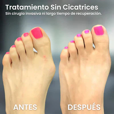🔥 PROMO 2X1 CORRECTOR DE JUANETES - RESULTADOS EN UN MÊS 🦴