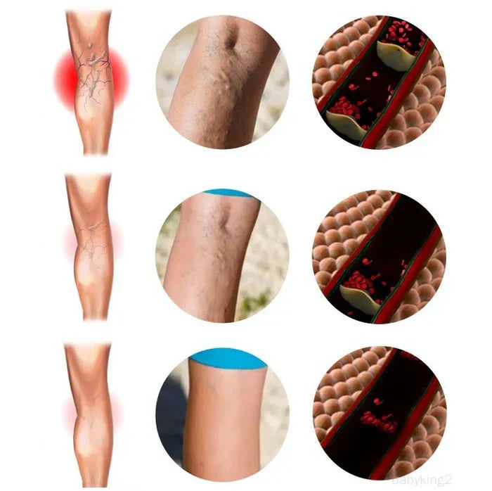 🚨(2x1)🚨Varicose Veins™ - Elimina Várices Rápidamente con el Spray Veins! 🌿 Alivio Efectivo y Natural 🚨2por1 😱