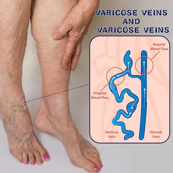🚨(2x1)🚨Varicose Veins™ - Elimina Várices Rápidamente con el Spray Veins! 🌿 Alivio Efectivo y Natural 🚨2por1 😱