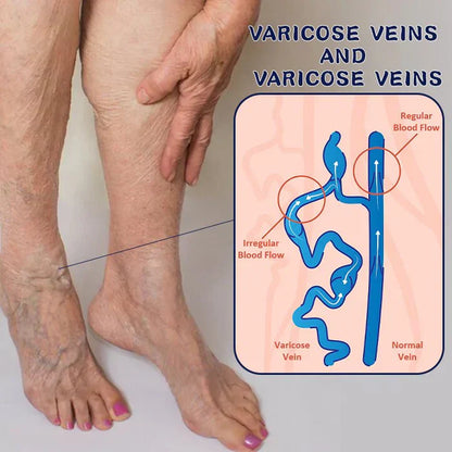 🚨(2x1)🚨Varicose Veins™ - Elimina Várices Rápidamente con el Spray Veins! 🌿 Alivio Efectivo y Natural 🚨2por1 😱