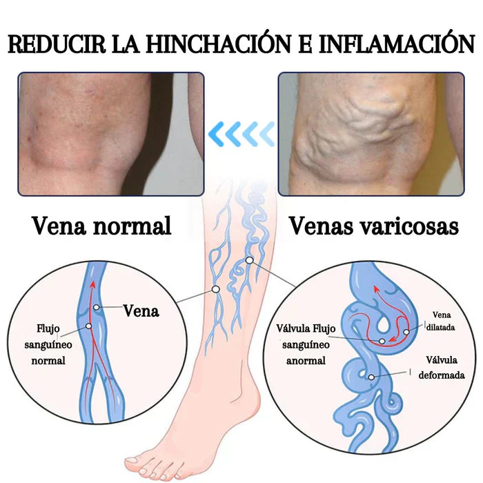 🚨(2x1)🚨Varicose Veins™ - Elimina Várices Rápidamente con el Spray Veins! 🌿 Alivio Efectivo y Natural 🚨2por1 😱