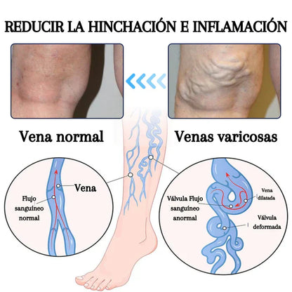 🚨(2x1)🚨Varicose Veins™ - Elimina Várices Rápidamente con el Spray Veins! 🌿 Alivio Efectivo y Natural 🚨2por1 😱